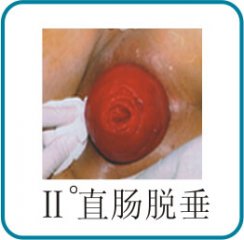 直肠脱垂症状及治疗_长沙肛肠医院_长沙东大
