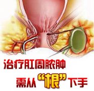 肛周脓肿治疗