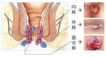 痔疮是什么样子的?图片有吗?_长沙东大肛肠医