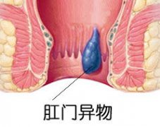 肛门长包包有哪些危害?