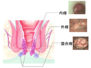 什么是痔疮?痔疮图片有吗?_长沙东大肛肠医院