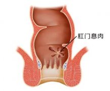 肛门口长肉是怎么回事?