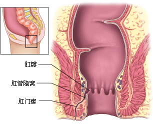 肛瘘形成原因的原因有哪些?