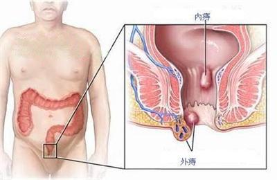 如何快速止内痔便血 17-140521093345U7.jpg
